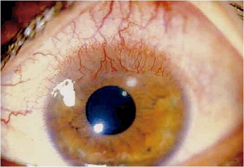 patologías asociadas al uso excesivo de lentes de hidrogel - Vision y Óptica