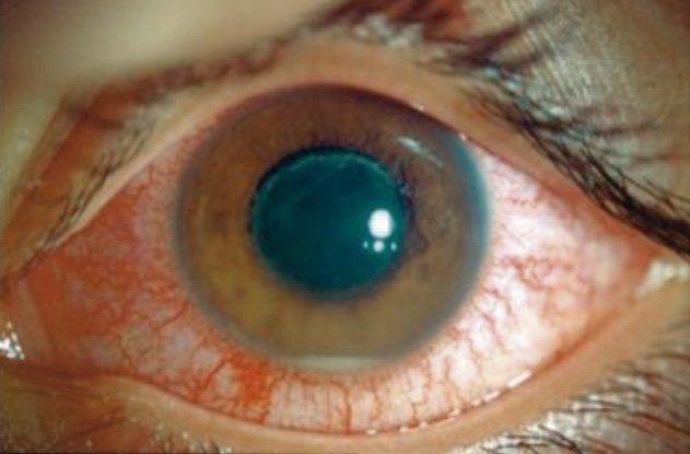 lanzador Interesar Hostal Principales patologías asociadas al uso excesivo de lentes de hidrogel -  Vision y Óptica