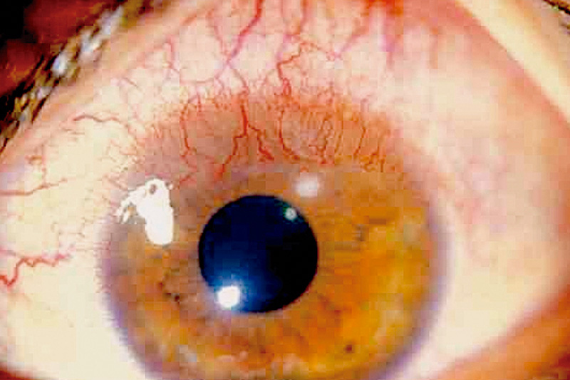 lanzador Interesar Hostal Principales patologías asociadas al uso excesivo de lentes de hidrogel -  Vision y Óptica