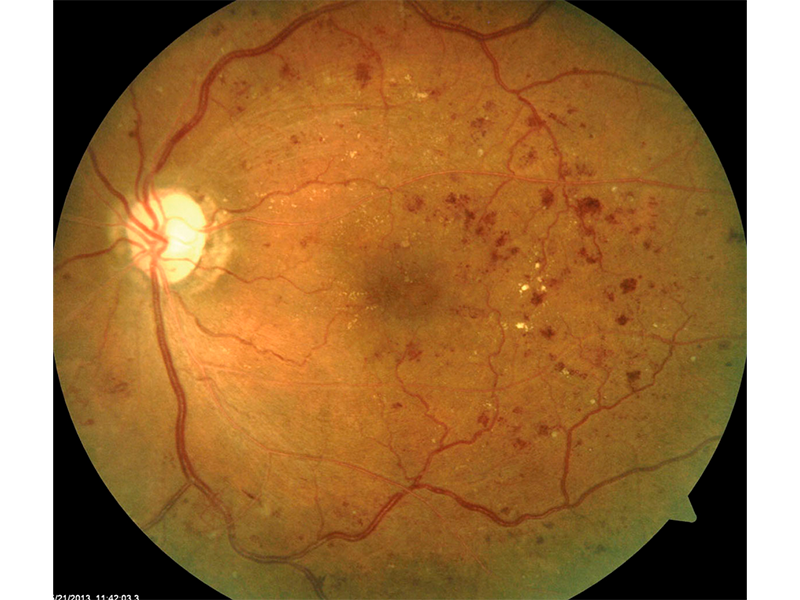 Por qué debes realizarte un fondo de ojoClínica de Oftalmología
