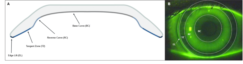 Figura 1A) Las partes de una lente de ortoqueratología: curva base (BC), curva inversa (RC), zona tangente (TZ), elevación de borde (EL). Figura 1B) El patrón de fluoresceína distinto correspondiente para cada sección de la lente (BC, RC, TZ, EL) (Imágenes: Johnson & Johnson Vision 2023).