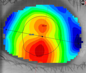 Figura 2. Mapa de curvatura axial de la topografía corneal. Las áreas rojas indican una curvatura más pronunciada en relación con las áreas azules más planas.