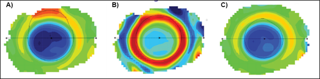 Figura 4A) Los mapas de diferencia axial ayudan a los profesionales a evaluar la regularidad del cambio corneal inducido por OrthoK. B) Los mapas de diferencia tangencial permiten que ECPS evalúe el centrado de la lente. C) Los mapas de diferencia de refracción permiten la interpretación del cambio medido en la refracción como resultado del tratamiento OrthoK. (Imágenes: Johnson & Johnson Visión 2023)