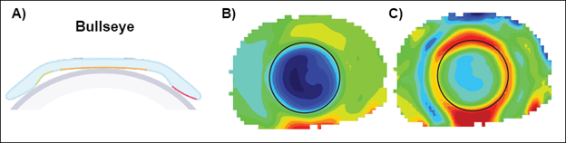 Figura 5. Ajuste de ortoqueratología Bullseye. 5A) La lente se asienta con un toque apical BC y un toque TZ optimizado. 5B) El mapa axial muestra una zona de tratamiento uniforme (azul) y 5C) El mapa tangencial muestra un centrado excelente caracterizado por el anillo rojo. (Imágenes: Johnson & Johnson Visión 2023)