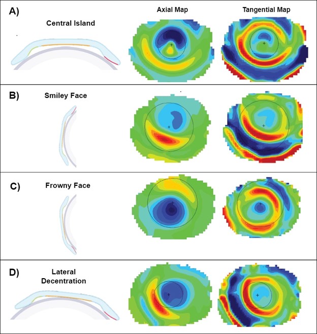 Figura 6: mapas de diferencia de topografía corneal para un ajuste de lente de ortoqueratología no óptimo. (Imágenes: Johnson & Johnson Visión 2023)