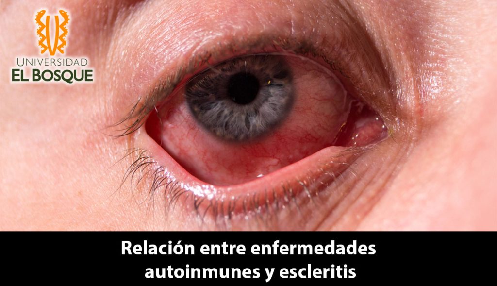 La escleritis es una condición inflamatoria que incluye en su presentación clínica edema e infiltración de células en la esclera y epiesclera, puede causar daños significativos en los tejidos circundantes, lo que puede llevar a complicaciones como cataratas, glaucoma o edema macular, resultando en pérdida de visión.