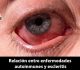 La escleritis es una condición inflamatoria que incluye en su presentación clínica edema e infiltración de células en la esclera y epiesclera, puede causar daños significativos en los tejidos circundantes, lo que puede llevar a complicaciones como cataratas, glaucoma o edema macular, resultando en pérdida de visión.