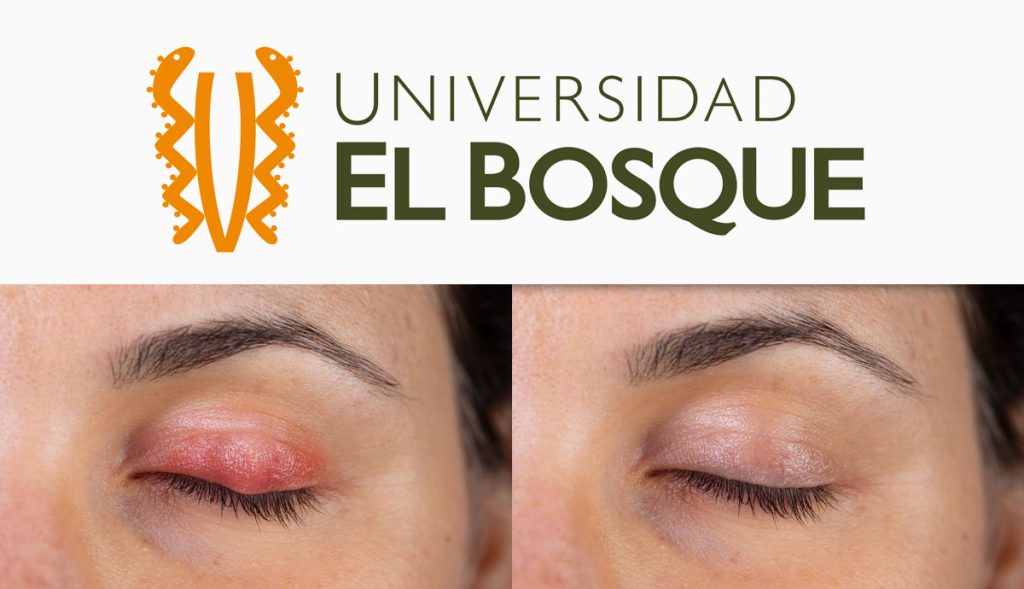 Celulitis secundaria a procedimientos quirúrgicos