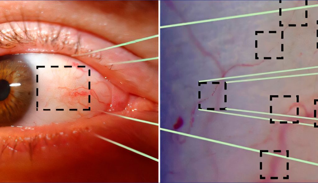 Un video ocular con IA podría sustituir las punciones para detectar anemia