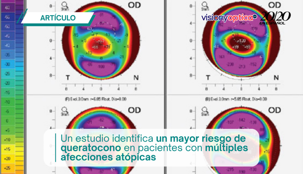 Un estudio identifica un mayor riesgo de queratocono en pacientes con múltiples afecciones atópicas